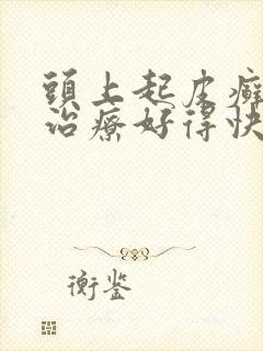 头上起皮癣怎么治疗好得快