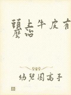 头上牛皮有癣怎么治