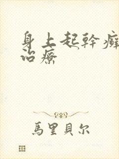 身上起干癣怎么治疗