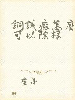 铜钱癣怎么治疗可以除根
