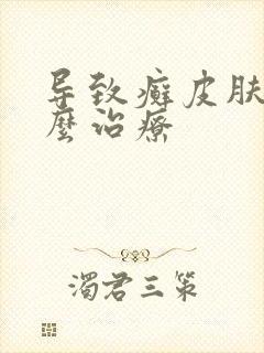 导致癣皮肤病怎么治疗