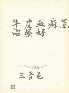 牛皮血癣怎么能治疗好