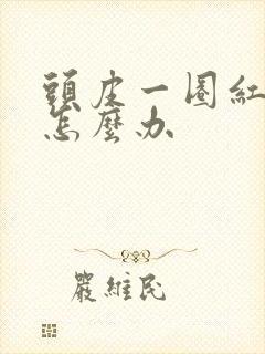 头皮一圈红像癣怎么办