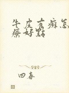 牛皮有癣怎么治疗好点