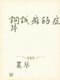 铜钱癣的症状图片