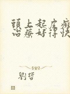 头上起皮癣怎么治疗好得快