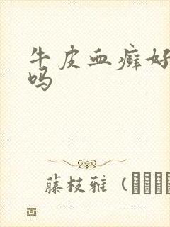 牛皮血癣好治疗吗