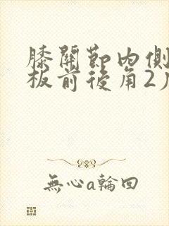 膝关节内侧半月板前后角2度损伤