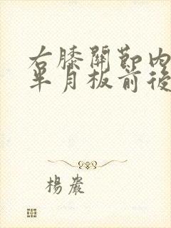 右膝关节内外侧半月板前后角损伤