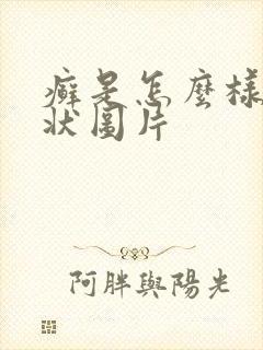 癣是怎么样的症状图片封面