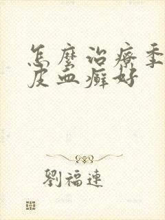 怎么治疗季节牛皮血癣好