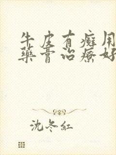 牛皮有癣用什么药膏治疗好的快些
