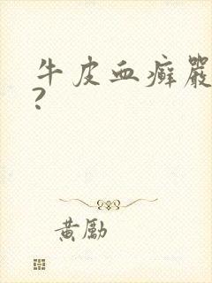 牛皮血癣严重吗?