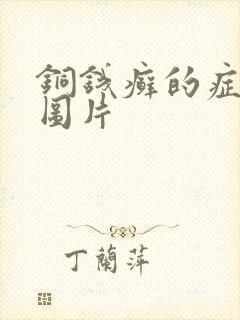 铜钱癣的症状及图片封面
