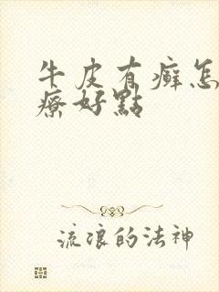 牛皮有癣怎么治疗好点