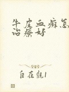 牛皮血癣怎么能治疗好