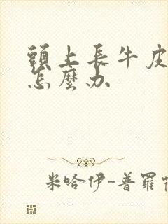头上长牛皮有癣怎么办