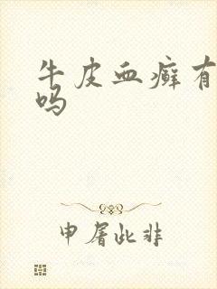 牛皮血癣有得治吗