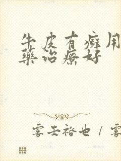 牛皮有癣用什么药治疗好