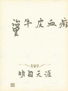 治牛皮血癣去哪里
