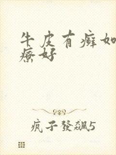 牛皮有癣如何治疗好