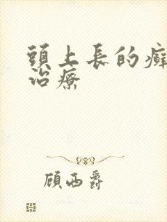头上长的癣怎么治疗