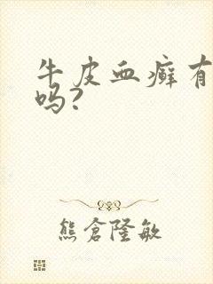牛皮血癣有得治吗?