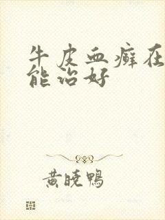 牛皮血癣在那里能治好