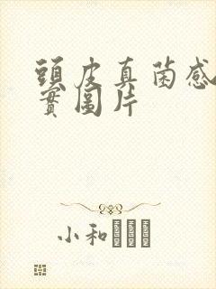 头皮真菌感染真实图片