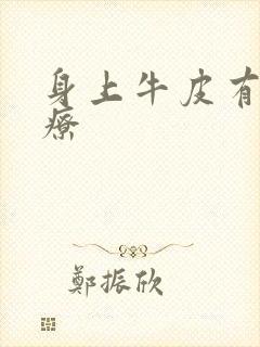 身上牛皮有癣治疗