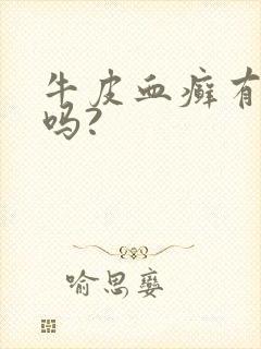 牛皮血癣有得治吗?