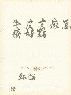 牛皮有癣怎么治疗好点