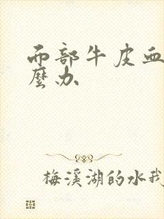 面部牛皮血癣怎么办