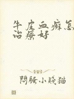 牛皮血癣怎么能治疗好